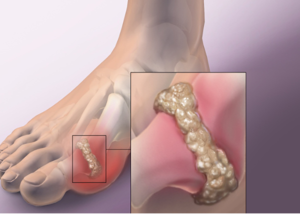 Nguyên tắc điều trị gout từ cơn cấp đến kiểm soát lâu dài