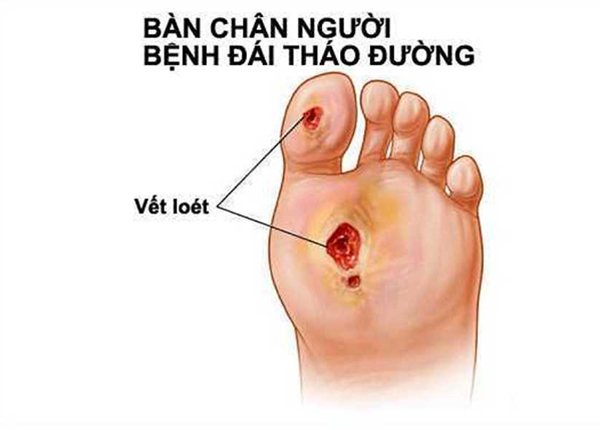B.s Trường Dược Sài Gòn chia sẻ thông tin bệnh bàn chân đái tháo đường