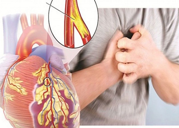 Bác sĩ cảnh báo nguy cơ mắc bệnh tim mạch do rối loạn lipid máu