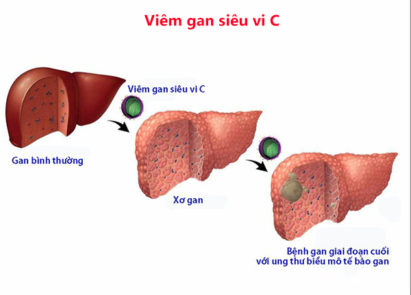 Bác sĩ Trường Dược Sài Gòn chia sẻ thông tin về bệnh viêm gan siêu vi C