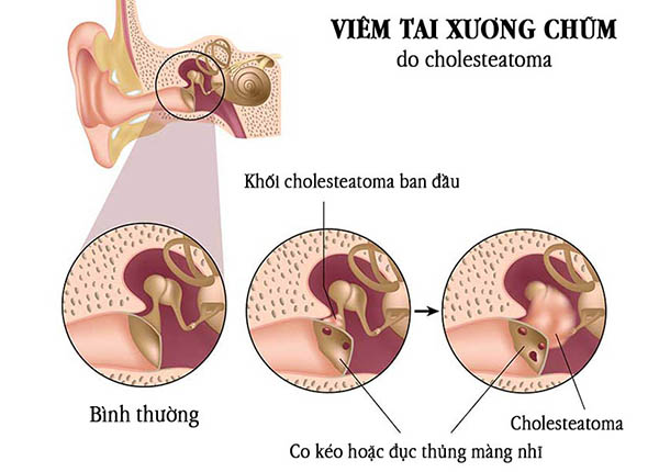 Bác sĩ Trường Dược Sài Gòn chia sẻ về bệnh viêm tai xương chũm
