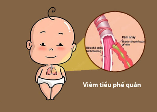 Bác sĩ Trường Dược Sài Gòn chia sẻ về bệnh viêm tiểu phế quản bội nhiễm