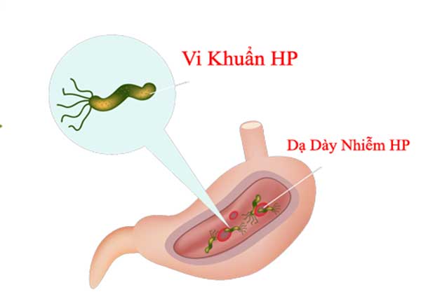 Để biets mình đau dạ dày do HP hay không nên đi xét nghiệm