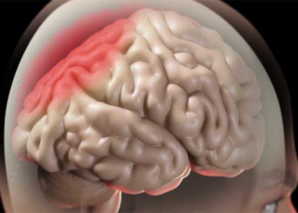Phù não có thể xảy ra ở những vị trí đặc biệt ở não hay phù toàn bộ não