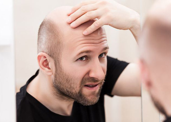 Bệnh rụng tóc hói đầu do di truyền có chữa được không?