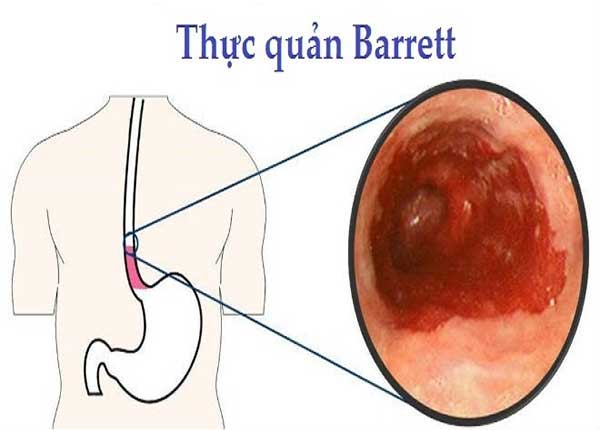 Triệu chứng của bệnh thực quản Barrett thường khá giống với trào ngược dạ dày thực quản
