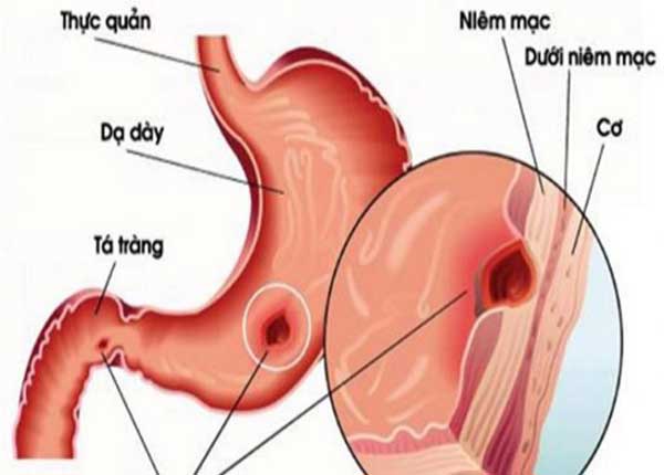 Xuất huyết tiêu hóa cũng có thể là biểu hiện của ung thư trực tràng