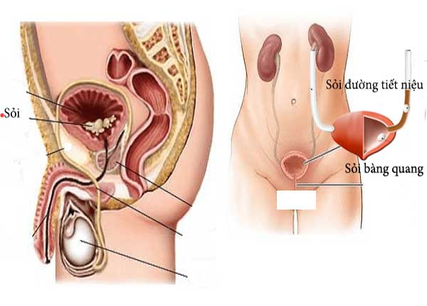 Có nhiều nguyên nhân gây ra sỏi bàng quang