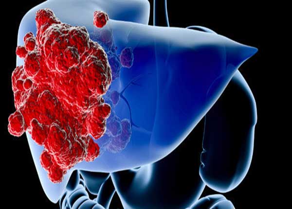 Ung thư biểu mô tế bào gan thường xảy ra ở những người có bệnh gan mãn tính