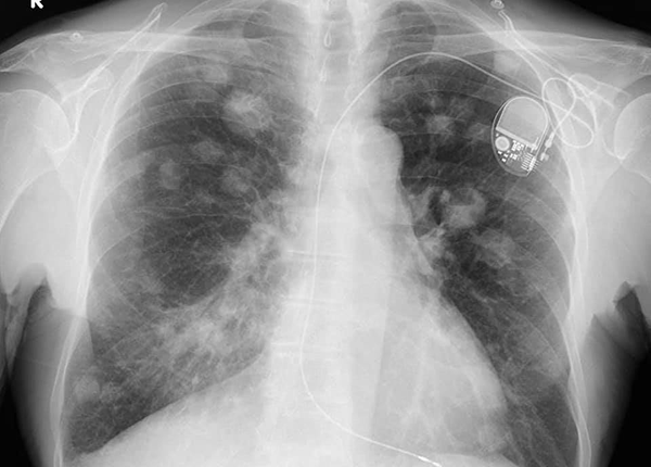 Biện pháp chẩn đoán phân biệt nốt phổi lan tỏa