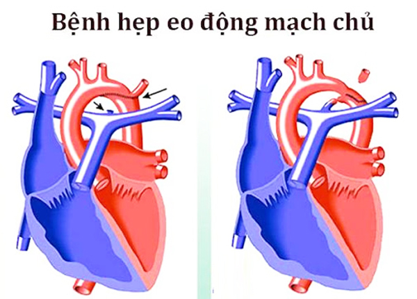 Hẹp eo động mạch chủ và lưu ý bệnh từ B.s Trường Dược Sài Gòn