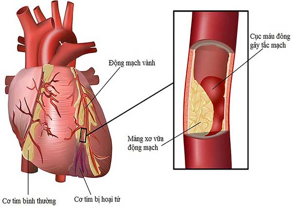 Hội chứng mạch vành là tăng nguy cơ gây tử vong