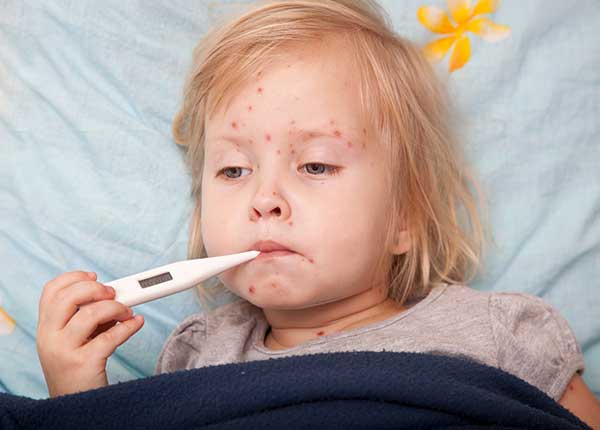 Bệnh sởi chủ yếu thường gặp ở trẻ em dưới 5 tuổi