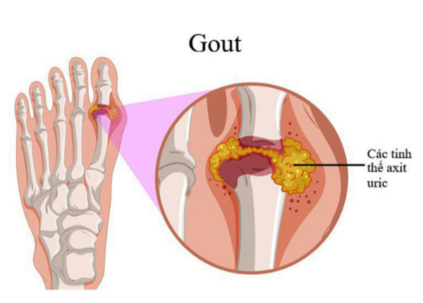 Những thông tin bạn cần nắm rõ về bệnh Gout