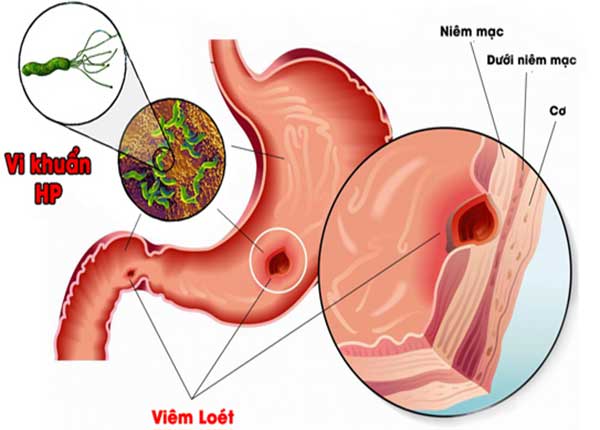 Vi khuẩn HP làm gia tăng nguy cơ bị bệnh đau dạ dày