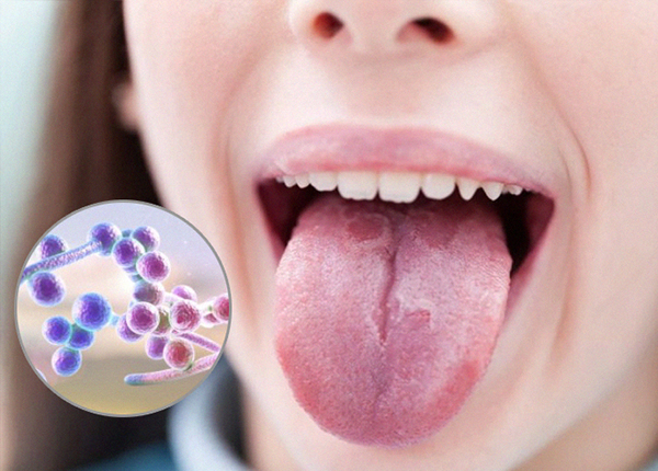 Chẩn đoán và điều trị tưa miệng ở trẻ em và người lớn an toàn