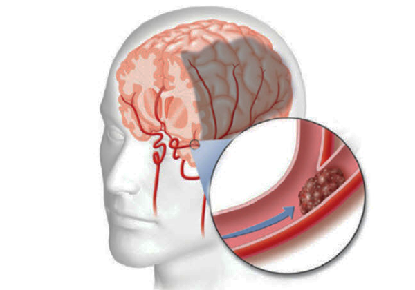 Y sĩ YHCT chia sẻ bài thuốc điều trị tai biến mạch máu não