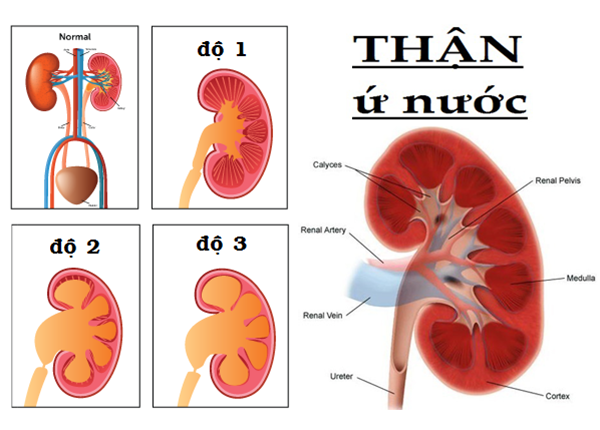 Thầy thuốc YHCT Sài Gòn tư vấn bài thuốc trị thận ứ nước