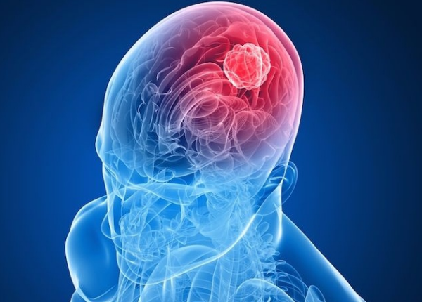 Những lưu ý quan trọng khi dùng thuốc trị u não lành tính