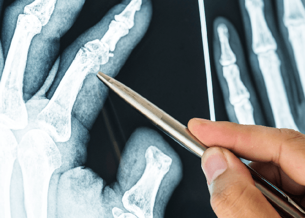 Tìm hiểu biện pháp chẩn đoán và điều trị tình trạng gãy xương