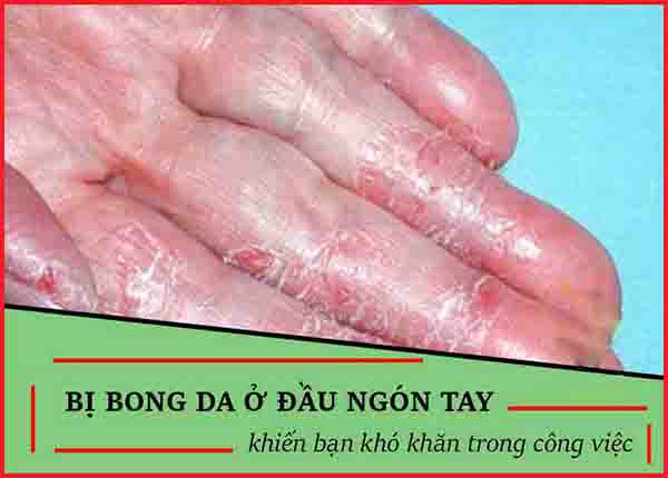 Tìm hiểu cách phòng ngừa tróc da ở đầu ngón tay từ B.s Trường Dược Sài Gòn
