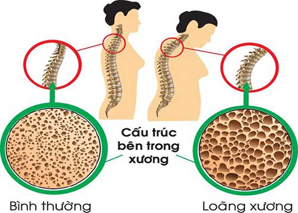 Phụ nữ có nguy cơ mắc bệnh loãng xương cao hơn nam giới