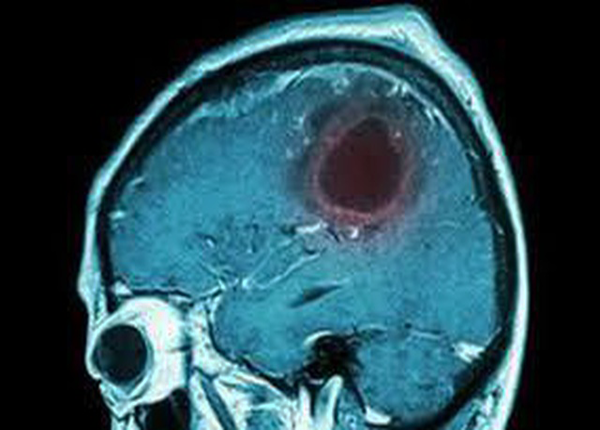 7 dấu hiệu cảnh báo khối u não bạn ko nên bỏ qua