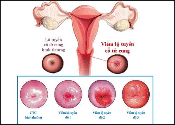 Các cấp độ của viêm lộ tuyến tử cung