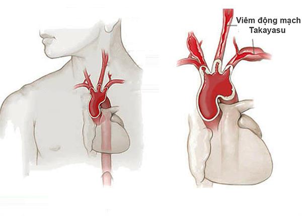 Bác sĩ giảng viên Trường Dược Sài Gòn nói gì về viêm động mạch Takayasu?