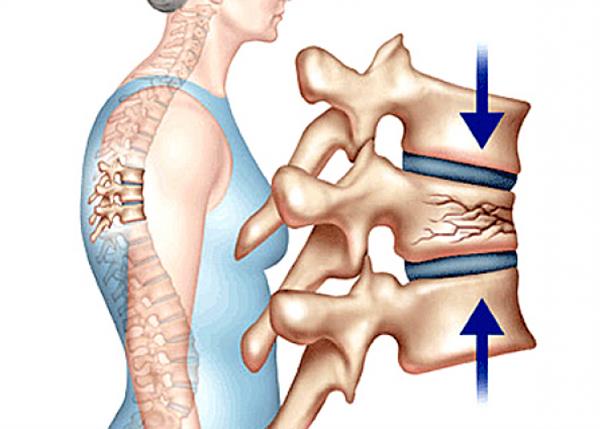 Bác sĩ Trường Dược Sài Gòn chia sẻ thông tin về bệnh xẹp đốt sống