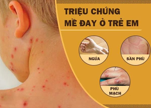 Bác sĩ Trường Dược Sài Gòn chia sẻ về bệnh nổi mề đay ở trẻ em