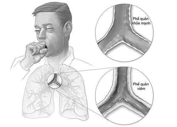 Bác sĩ Trường Dược Sài Gòn chia sẻ về bệnh viêm phế quản co thắt