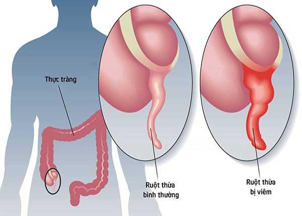 Bác sĩ Trường Dược Sài Gòn chia sẻ về bệnh viêm ruột thừa