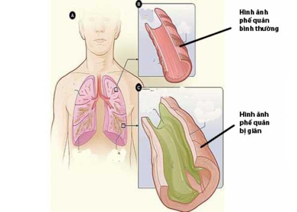 Chia sẻ của bác sĩ Trường Dược Sài Gòn về bệnh giãn phế quản