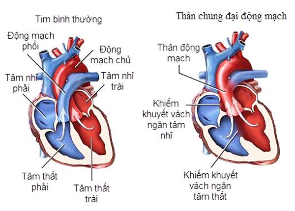 Chuyên gia Điều dưỡng Sài Gòn chia sẻ về bệnh Thận chung động mạch