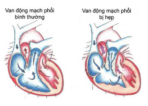 Cùng B.s Trường Dược Sài Gòn tìm hiểu về bệnh hẹp van động mạch phổi