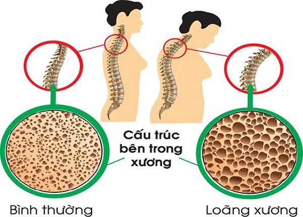 Cùng Dược sĩ Sài Gòn điều trị bệnh loãng xương