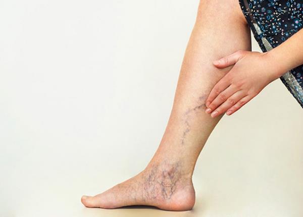 Dấu hiệu nhận biết suy tĩnh mạch chi dưới và cách phòng ngừa hiệu quả