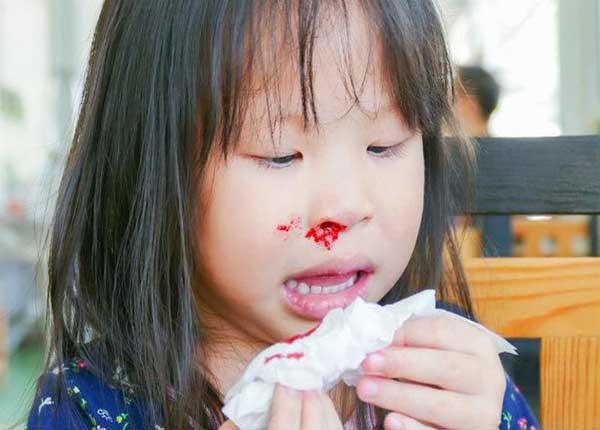 Điều dưỡng Sài Gòn chia sẻ cách xử trí khi trẻ bị chảy máu cam