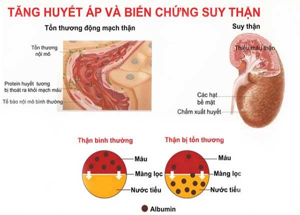 Điều dưỡng Sài Gòn chia sẻ mối quan hệ giữa tăng huyết áp và bệnh thận