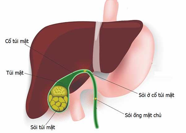 Điều dưỡng viên chia sẻ nguyên nhân và phương pháp điều trị sỏi mật