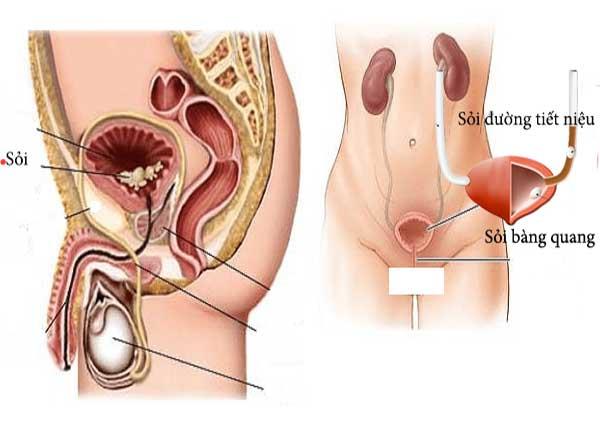 Dược sĩ Sài Gòn chia sẻ nguyên nhân và cách điều trị sỏi bàng quang