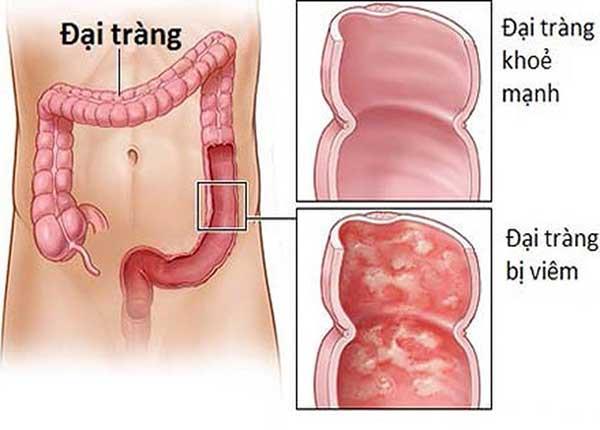 Dược sĩ Sài Gòn chia sẻ những loại thuốc chữa bệnh viêm đại tràng co thắt