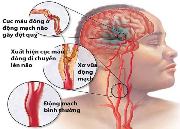 Những bài thuốc Y học cổ truyền phòng chống xơ vữa động mạch não