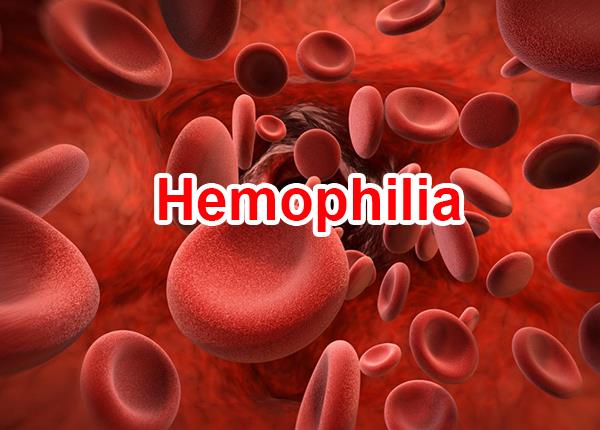 Những lưu ý về bệnh Hemophilia từ B.s Trường Dược Sài Gòn