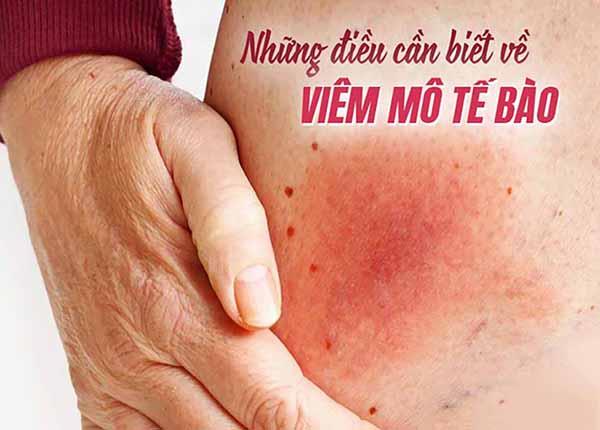 Những lưu ý về bệnh viêm mô tế bào