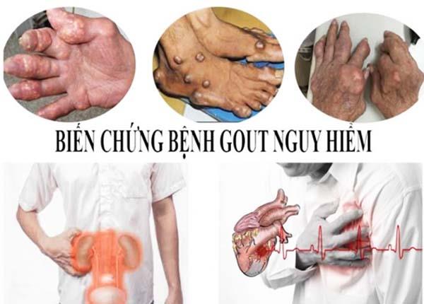 Tìm hiểu biện pháp ngăn ngừa nguy cơ gút phát sinh biến chứng