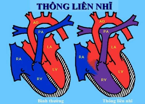 Tìm hiểu căn bệnh thông liên nhĩ với giảng viên Trường Dược Sài Gòn