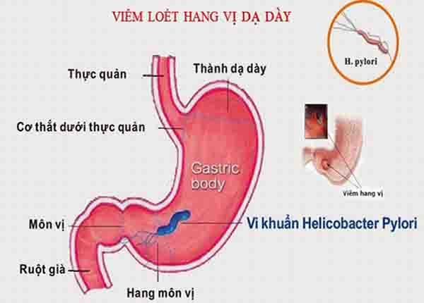 Tìm hiểu phương pháp điều trị bệnh viêm hang vị dạ dày có vi khuẩn hp