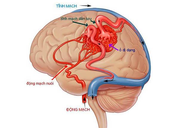 Tìm hiểu sự nguy hiểm của bệnh dị dạng mạch máu não